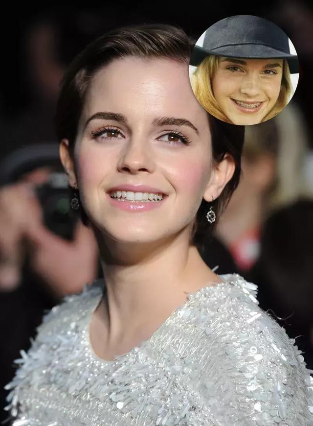 還在猶豫是否整牙，明星們默默變美都在靠它，你想知道的這篇都有