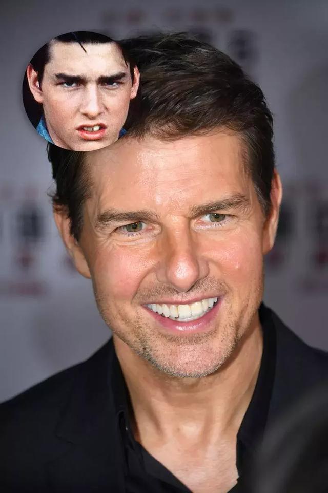 還在猶豫是否整牙，明星們默默變美都在靠它，你想知道的這篇都有