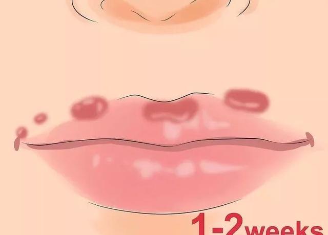 嘴上長泡，暗藏6種致命疾病，做對5件事清火排毒！