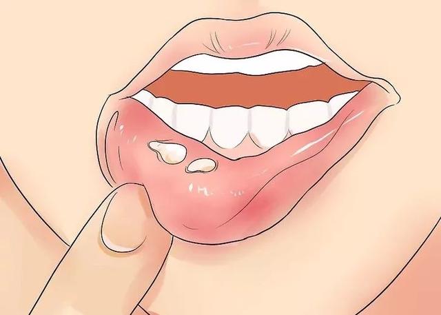 嘴上長泡，暗藏6種致命疾病，做對5件事清火排毒！