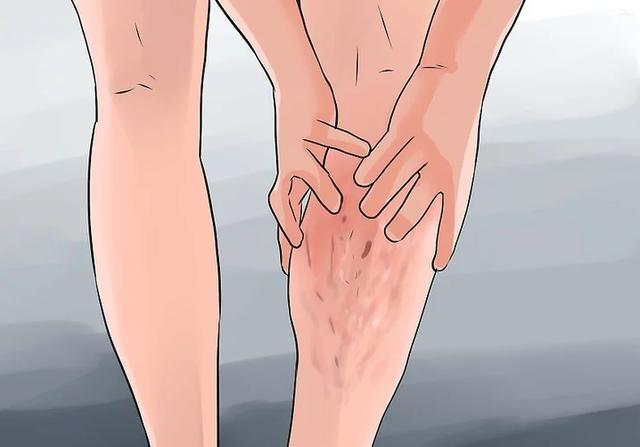 中國有1億靜脈曲張患者，常做3個小動作，幫你遠離靜脈血栓