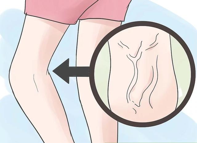 3類人是靜脈曲張的“常客”，出現6個信號，就要小心了