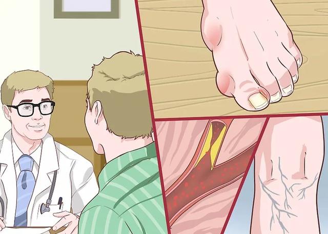 3類人是靜脈曲張的“常客”，出現6個信號，就要小心了