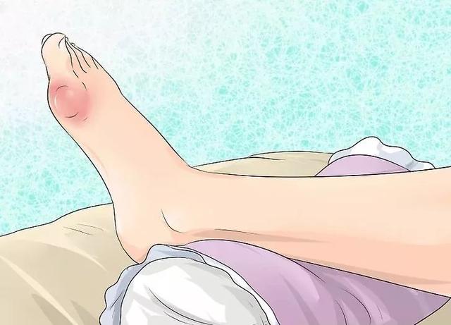 尿酸高的人，身體會出現5種表現，若1個也不佔，說明尿酸控制不錯