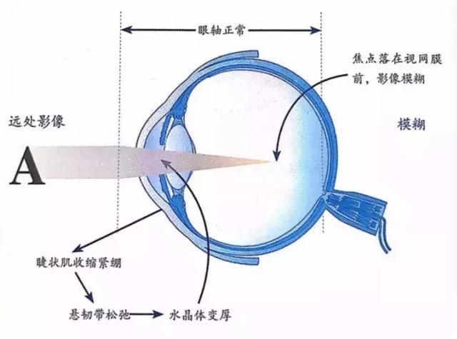 關於孩子視力的10個真相，爸媽要警惕，變成高度近視就後悔莫及了