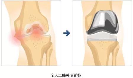 “膝蓋”疼？ 恐怕沒你想得那麼簡單