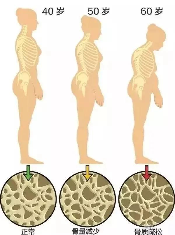 骨質疏鬆真不是中老年人的專利！ 四招助你補足鈣