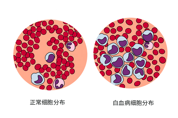 白血病和家裡的環境有關嗎? 如果孩子出現4種症狀,需要重視