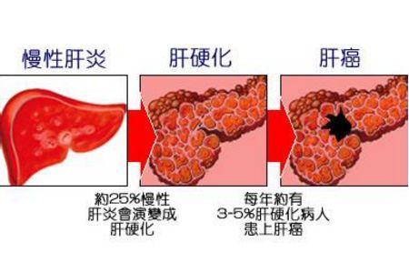 身體出現這10個症狀，可能是肝臟變硬了！
