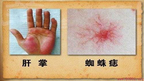 身體出現這10個症狀，可能是肝臟變硬了！