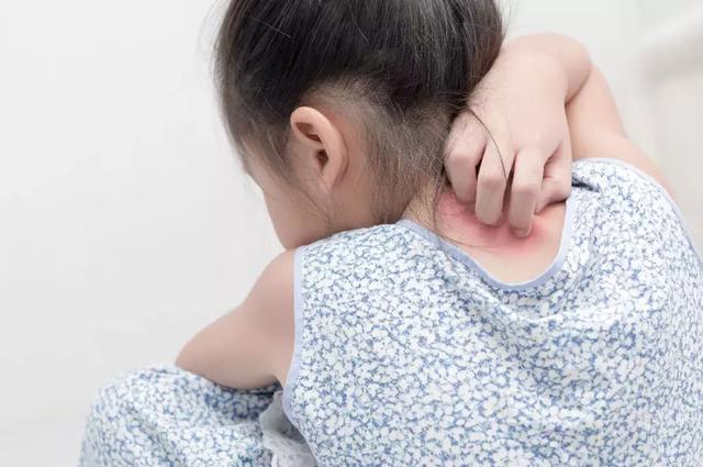 孩子長濕疹，大了自然好？ 照顧不周或困擾半生！