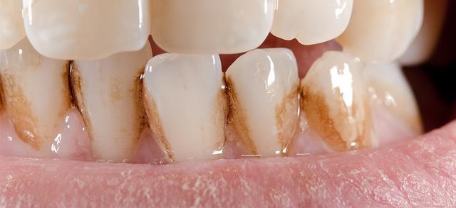 牙科醫生評出10種染色食物，越吃你的牙越黑
