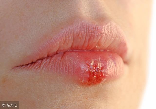 口腔潰瘍接吻，會不會被感染艾滋？ 醫生透露：一種情況真的有可能
